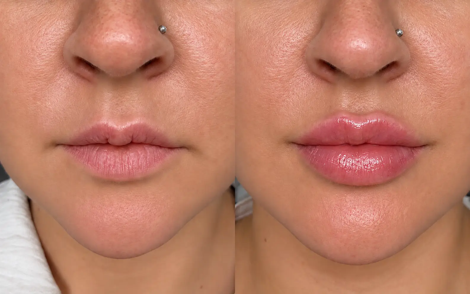 Original Alixir lip enhancement result: before on the left and after on the right